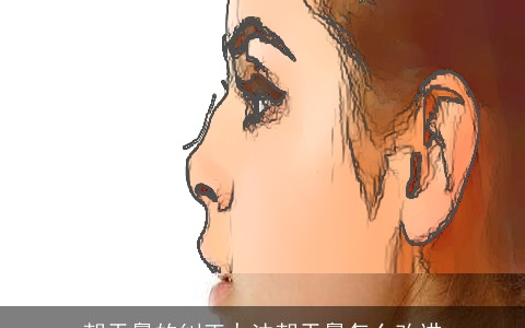 朝天鼻的纠正办法朝天鼻怎么改进