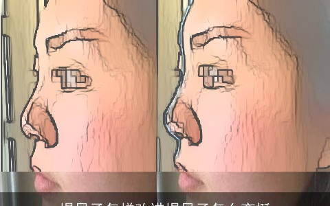 塌鼻子怎样改进塌鼻子怎么变挺