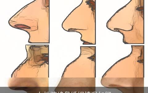 女性驼峰鼻婚姻情况如何