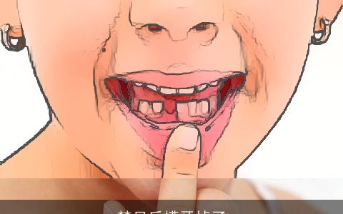 梦见后槽牙掉了