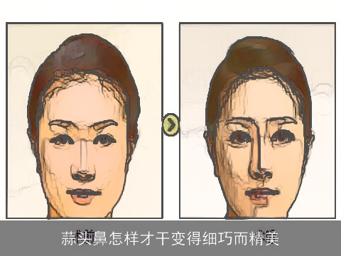 蒜头鼻怎样才干变得细巧而精美