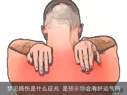 梦见烧伤是什么征兆 是预示你会有好运气吗