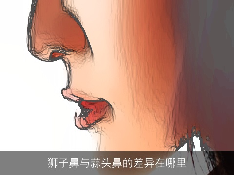 狮子鼻与蒜头鼻的差异在哪里