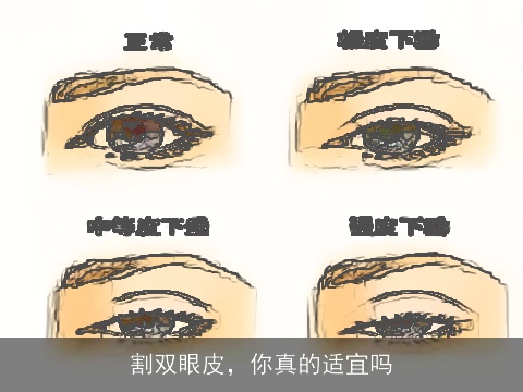 割双眼皮，你真的适宜吗