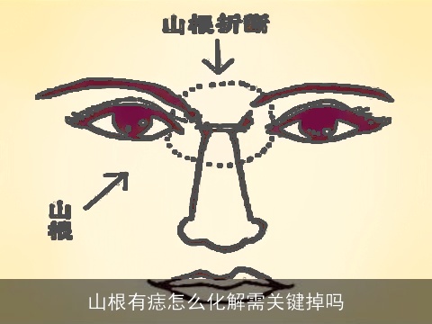 山根有痣怎么化解需关键掉吗